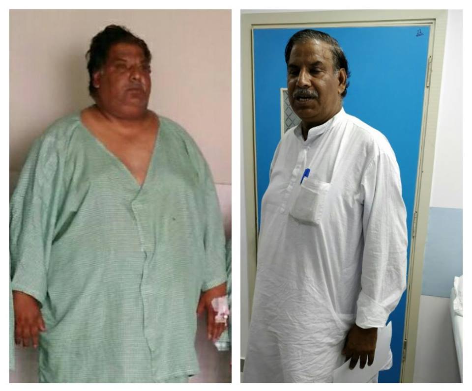 The life after Bariatric surgery